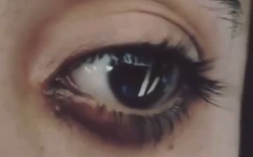 В некоторых случаях пациентам в глаза вставляют имплантат с препаратом – подробности