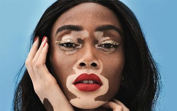 Лечится ли витилиго и почему пятна на коже так быстро растут