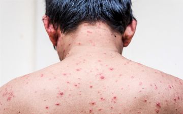 Терапевт из Узбекистана развеяла семь мифов о ветрянке — подробности