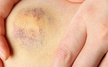 Врач рассказал, чем могут быть опасны синяки — у вас может быть болезнь крови