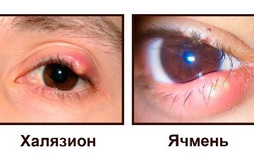 Педиатр из Узбекистана рассказал об отличии ячменя от халязиона