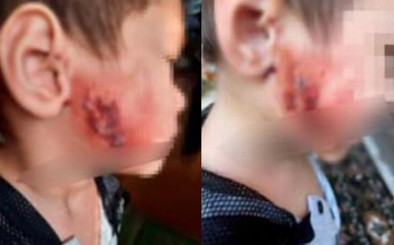 В Ташкенте воспитательница детсада обожгла лицо трехлетнему ребенку