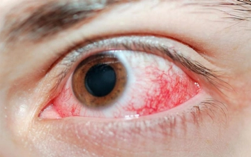 Девочка обожгла глаза и веки из-за наращивания ресниц