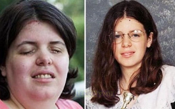 Девушка залила глаза химикатом, чтобы стать трансинвалидом