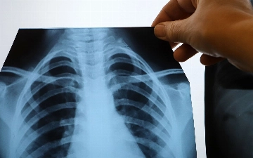 Узбекистан направит почти $60 млн на борьбу с туберкулезом 