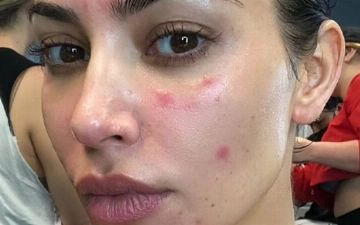 Ким Кардашьян честно рассказала о проблемах с кожей
