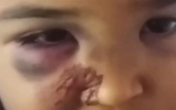 Стали известны детали инцидента с ребенком, пришедшим в детсад с огромным синяком