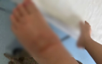 В одном из детских садов Намангана на ногу маленькой девочки пролили кипяток
