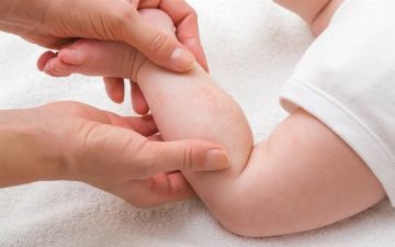 Специалист рассказал о причине появления аллергии у детей 