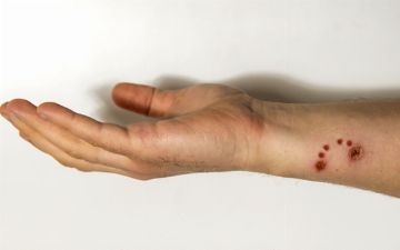 Как человек заражается бешенством и как вирус распространяется в организме?