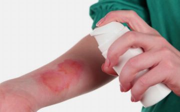 Что делать при разных видах ожогов