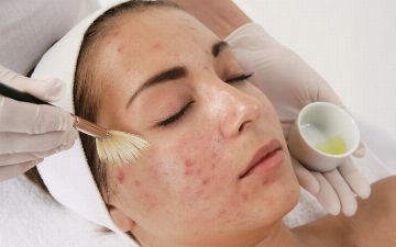 Акне: рассказываем о причинах появления и способах лечения