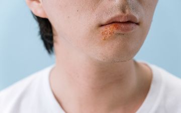 Какие первые симптомы ВИЧ и СПИДа