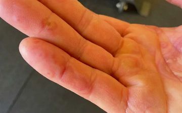 Дерматолог поведала о «ковидной руке» после вакцинации