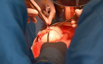 Как обстоят дела с пересадкой почек в Узбекистане — рассказываем