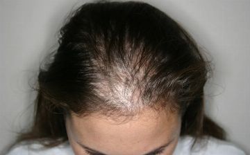 Узбекский терапевт рассказала, должны ли волосы выпадать каждый день или это патология