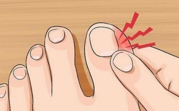 Как вылечить грибок на ногтях ног - 3 способа