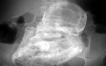 Недоразвитый сиамский близнец превратился внутри женщины в опухоль с зубами и волосами — пациентку прооперировали