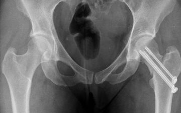 Узбекский терапевт рассказала, чем опасен перелом шейки бедра