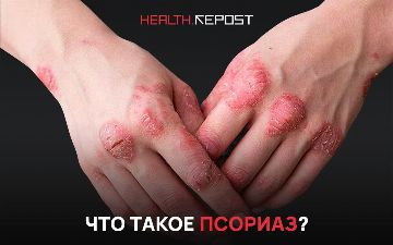 «Мое настроение напрямую влияет на развитие болезни»: что такое псориаз