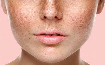 Узбекский терапевт объяснила, что такое пигментные пятна и какими они бывают