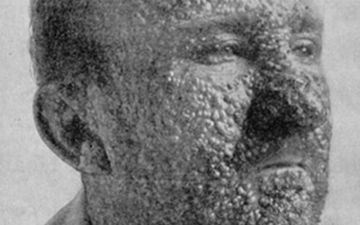 Какие болезни человечество победило благодаря вакцинации?