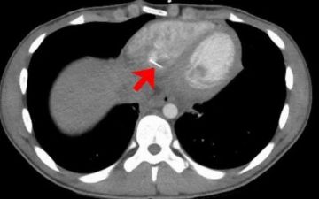 В сердце молодого человека попала булавка, ее удалили