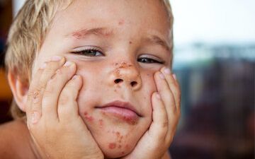 Псориаз у детей: как обезопасить своего ребенка