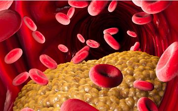 Врачи сообщили, как определить высокий холестерин по походке человека