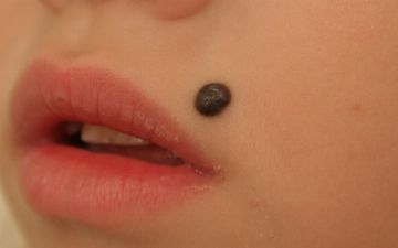 Что делать, если вы содрали родинку? 