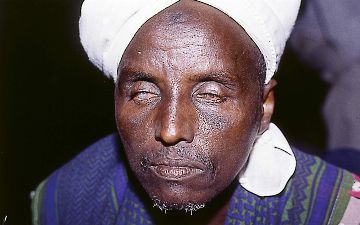 Что может привести к слепоте? Рассказываем о трахоме