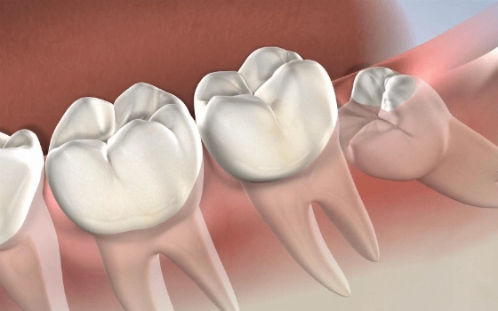 Зачем удалять зубы мудрости: вся правда о «восьмерках»