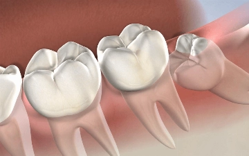 Зачем удалять зубы мудрости: вся правда о «восьмерках»