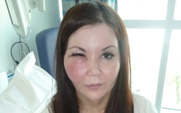 Женщина перенесла множество операций, чтобы восстановить внешность после филлеров