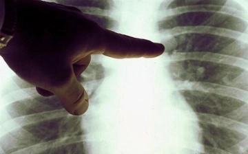 WSJ: Во всем мире наблюдается рост заболеваемости раком среди молодого поколения