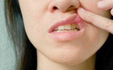 Можно ли в домашних условиях избавиться от стоматита
