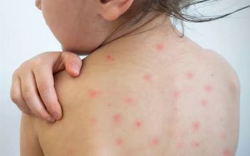 Неонатолог из Узбекистана раскрыла подробности краснухи у детей