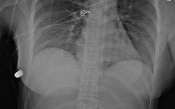 Грудной имплант спас женщину от пули