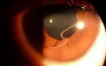 Узнайте о паразите, который проникает в организм человека и добирается до глаз — видео