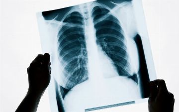 В Минздраве поведали об еще трёх умерших пациентах от пневмонии