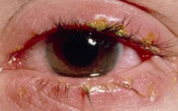 Как выглядит острое воспаление краев век и как его лечить