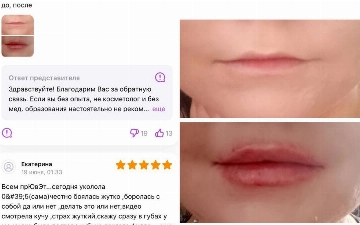 Девушки начали самостоятельно увеличивать себе губы филлерами с маркетплейсов