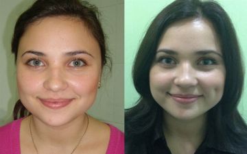 Узнайте, как проходит операция по созданию ямочек на щеках – диплэктомия