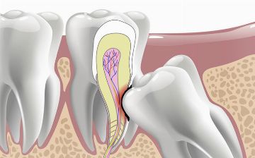 Почему зубы мудрости появляются очень поздно?
