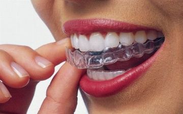 Что лучше выбрать: брекеты или каппы-элайнеры