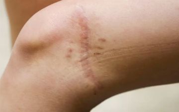 Физиотерапевт из Узбекистана рассказала, в чем главная проблема рубцов на теле