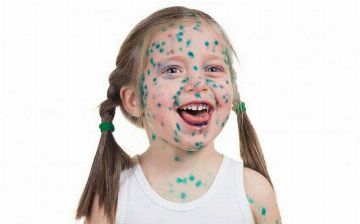 Узбекский педиатр рассказал, к каким осложнениям может привести ветрянка