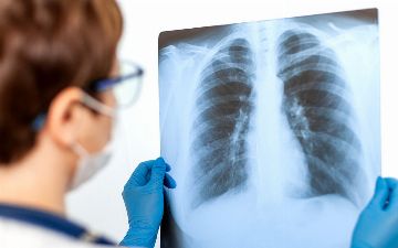 За прошедшие сутки у 24 узбекистанцев выявили пневмонию — статистика