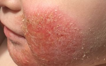 Аллергия может помочь в борьбе с коронавирусом — очень неожиданно