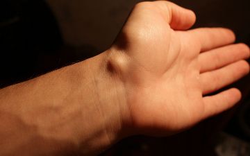 Шишка на руке подростка оказалась редкой формой рака